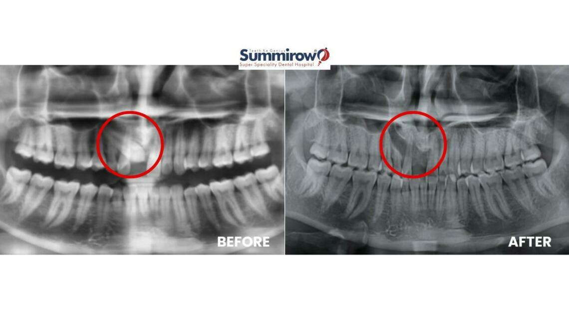 Impacted Canine Surgery: Successful Removal of an Impacted Upper Canine
