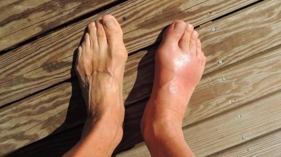 Raised Uric Acid Level Causes Gout: A Case of Mistaken Identity?!