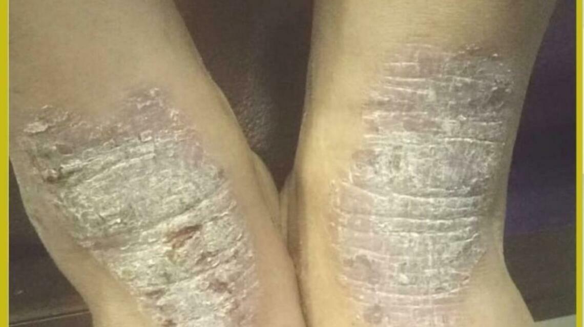 Eczema Made Easy by Ayurveda