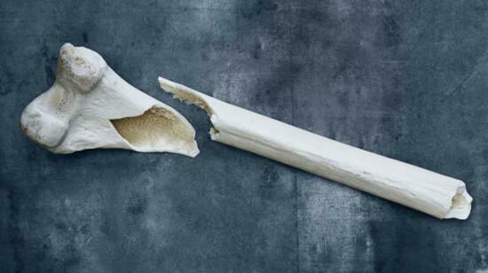 Osteoporosis & Hip Fractures in Elderly Patients: The Silent Decline You Must Not Ignore