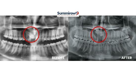 Impacted Canine Surgery: Successful Removal of an Impacted Upper Canine