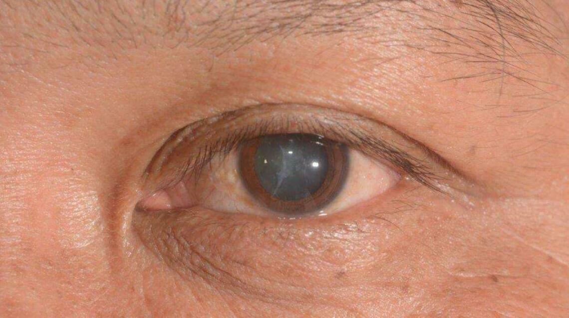 Understanding Cataracts: Recognizing the Warning Signs