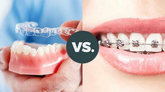 Myths About Orthodontic Treatment: Clear Aligners & Braces