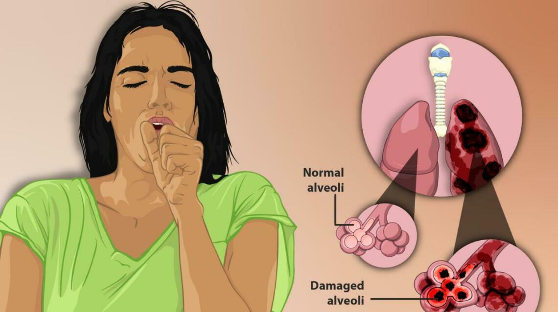Understanding Chronic Obstructive Pulmonary Disease