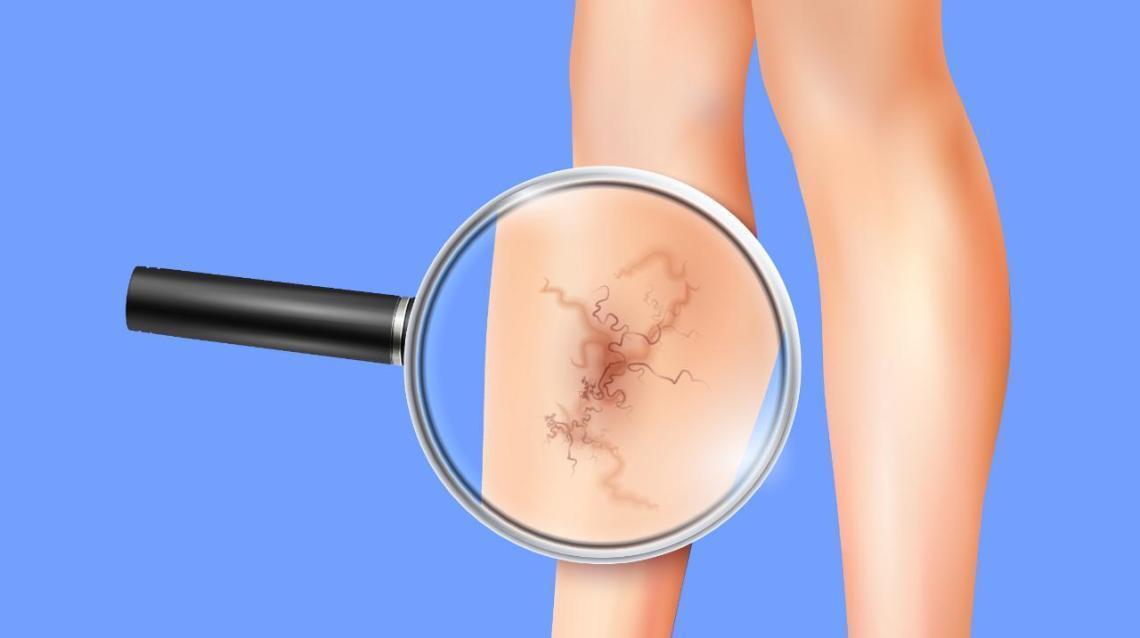 Symptoms and Complications of Varicose Veins