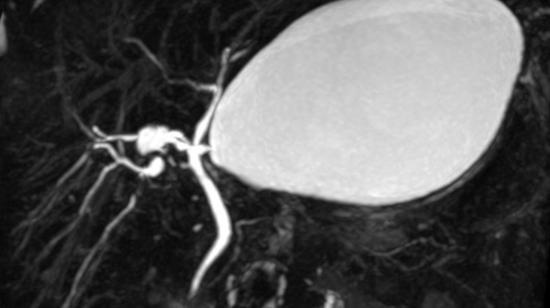 Why Mrcp Is Must Before Cholecystectomy for Patients With Gall Bladder Calculi?