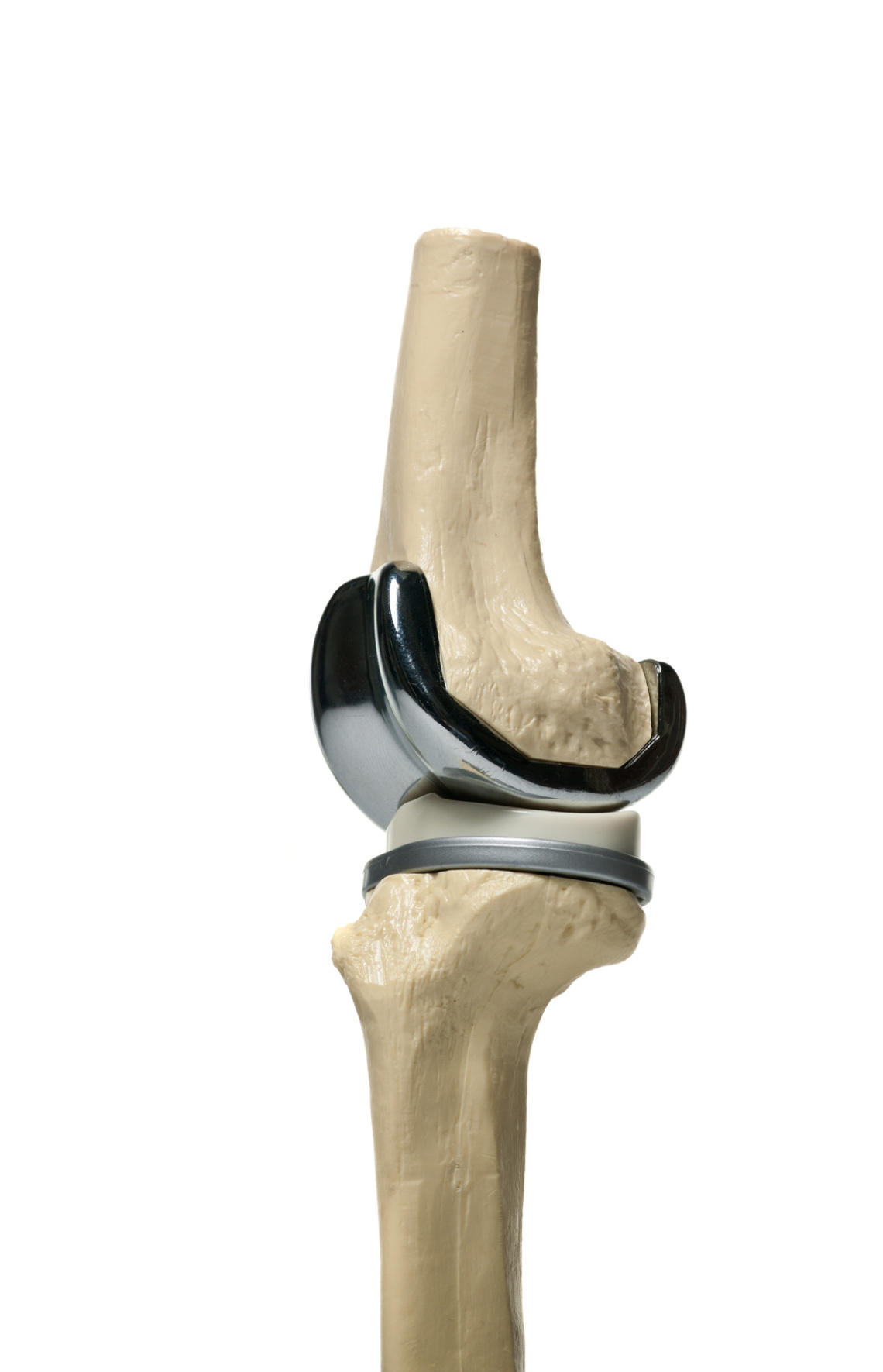 Do I Require a Knee Replacement Surgery?