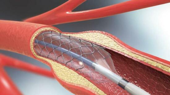 Life After Angioplasty: Must-Follow Habits for a Healthy Heart