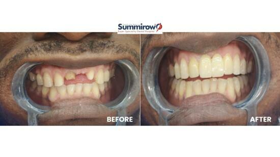 Smile Rehabilitation With Esthetic Crown and Veneer Replacement