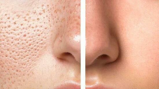 Open Pores-Causes, Myths, Treaments