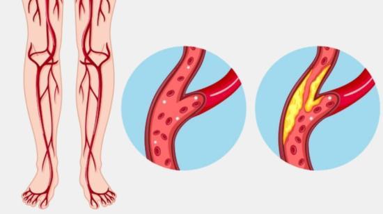 Peripheral Arterial Occlusive Disease (Paod): Cause of a "Leg Attack"