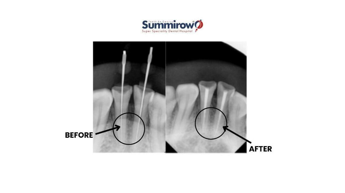 Single-Sitting Root Canal Treatment in Lower Front Teeth