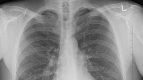 Pulmonology Myths Debunked: Common Misconceptions About Lung Health
