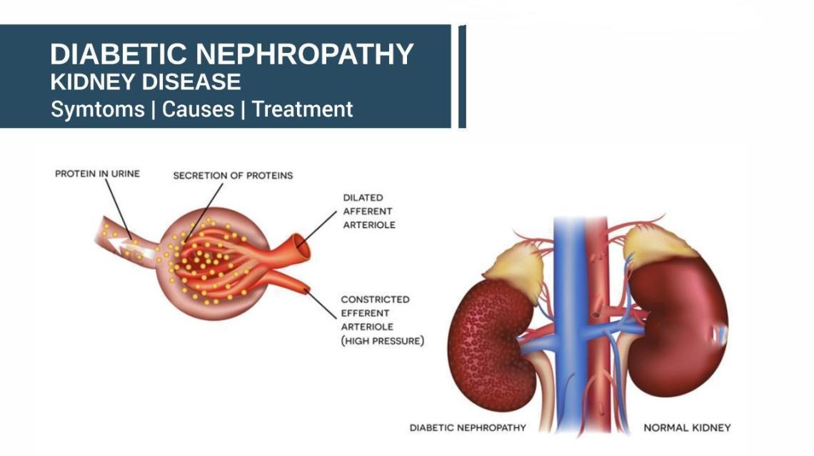 Understanding Diabetic Kidney Disease