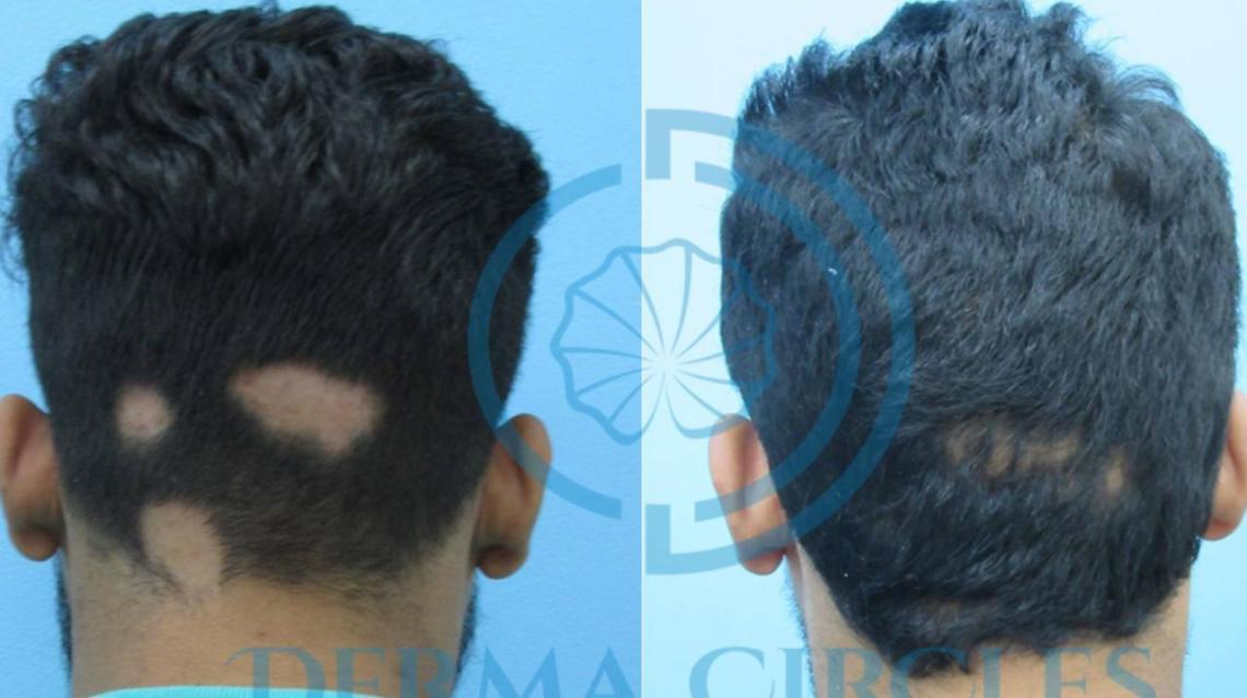 Alopecia Areata Latest Treatment Guidelines