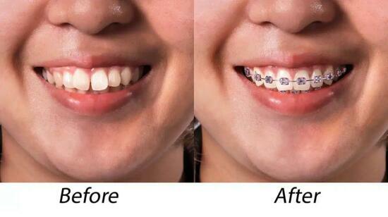 Why Not Every Crooked Tooth Needs Braces