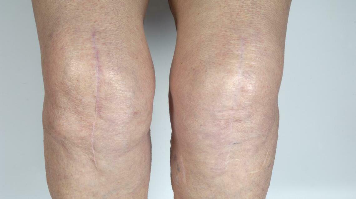 Total knee replacement