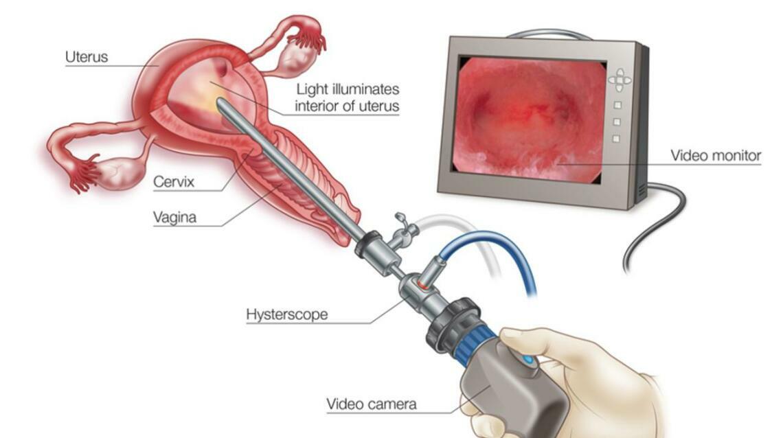 Hysteroscopy:a Modern, Painless Solution for Uterine Problems