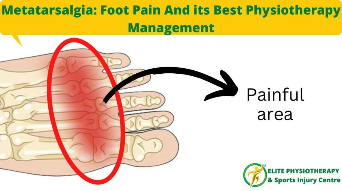 Metatarsalgia Foot Pain and Its Best Physiotherapy Management