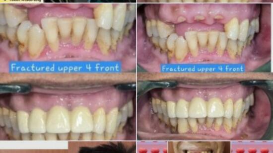 Title:rehabilitation of Fractured Maxillary Anterior Teeth Using Dental Implants and Crowns