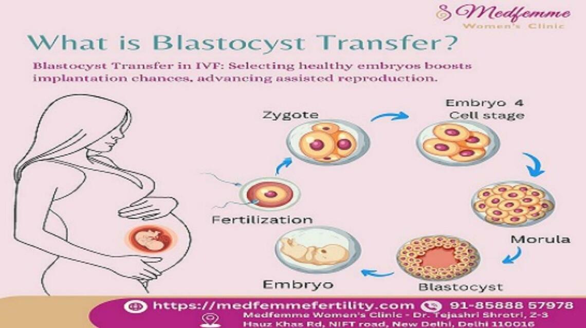 Blastocyst Transfer A Powerful Step in Your Ivf Journey