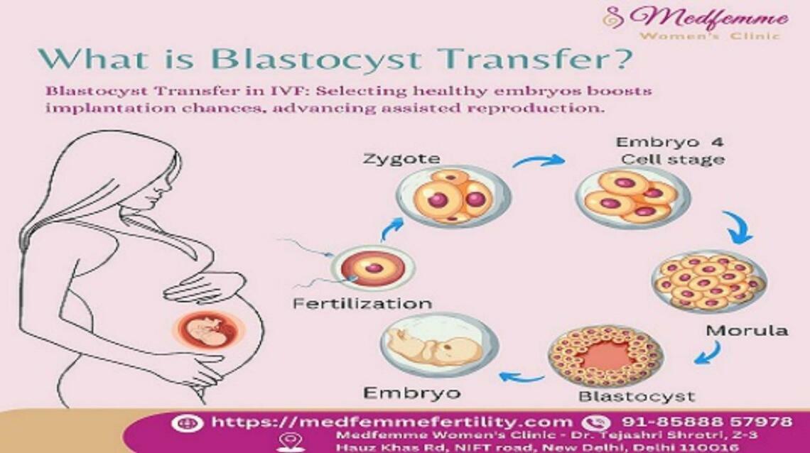 Blastocyst Transfer: A Powerful Step in Your Ivf Journey