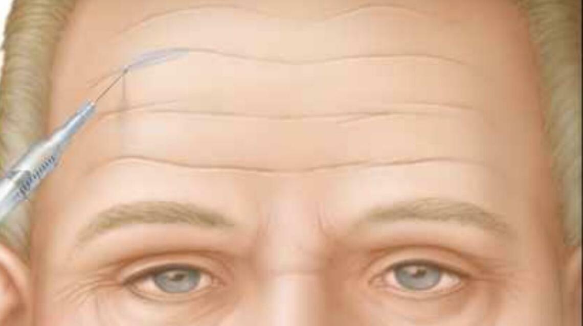 The Science Behind Botox