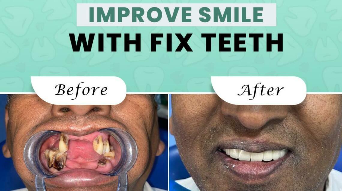 How Much Does a Dental Implant Cost in Nagpur? (Updated 2026)