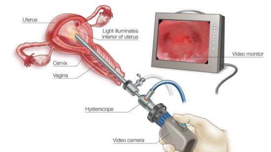 Hysteroscopy:a Modern, Painless Solution for Uterine Problems