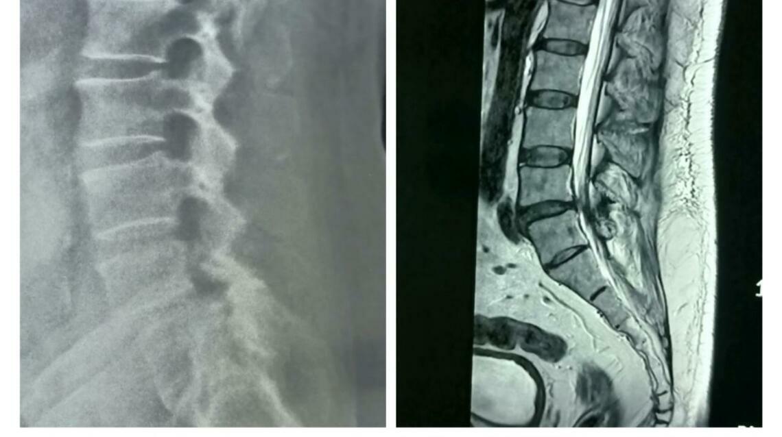 Endoscopic Spinal Fusion for L4–l5 Spondylolisthesis: A Minimally Invasive Success Story