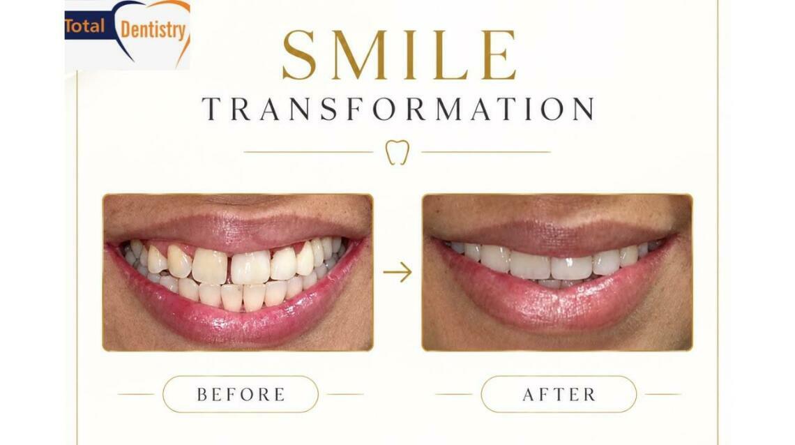 A gap Between Your Front Teeth?