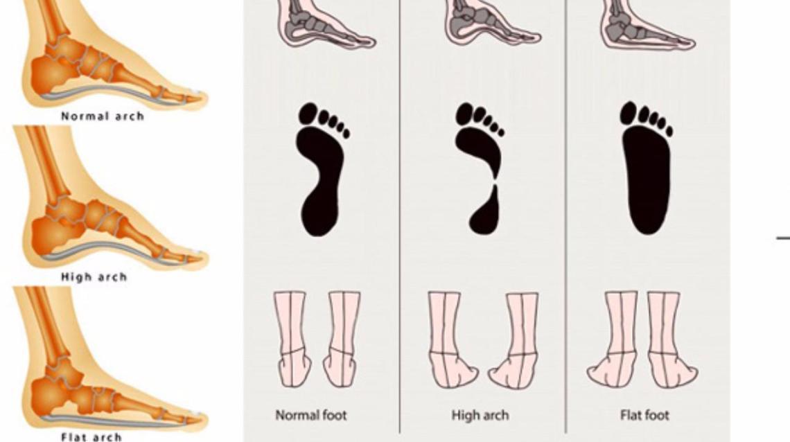 Artificial arch for flat feet sale
