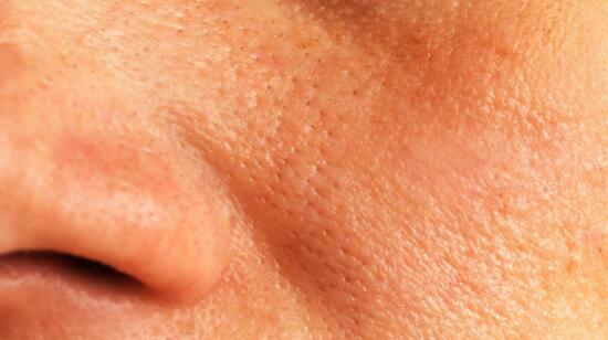 Enlarged Pores: Causes & Management