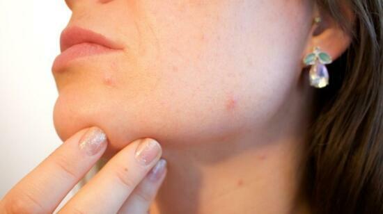 Top 5 Acne Myths That Are Secretly Making Your Skin Worse
