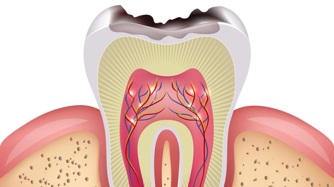 Is Root Canal Treatment Painful?