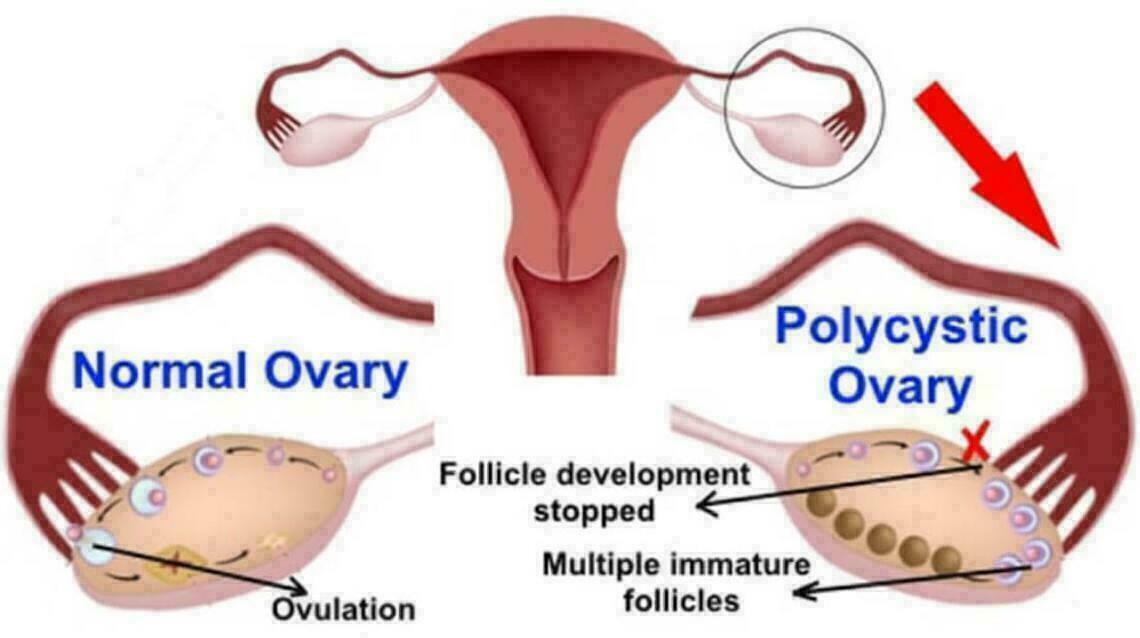 Pcos/pcod Treatment Part 2