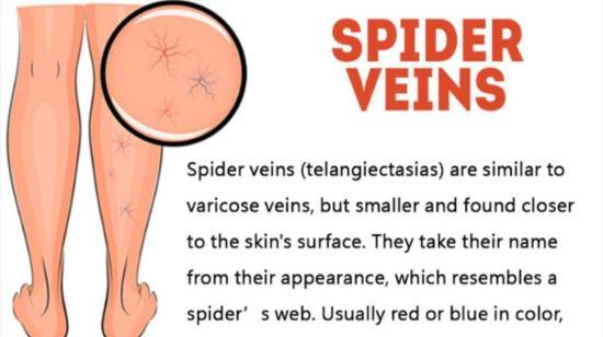 Spider Veins(telangiectasias) Are Similar to Varicose Veins