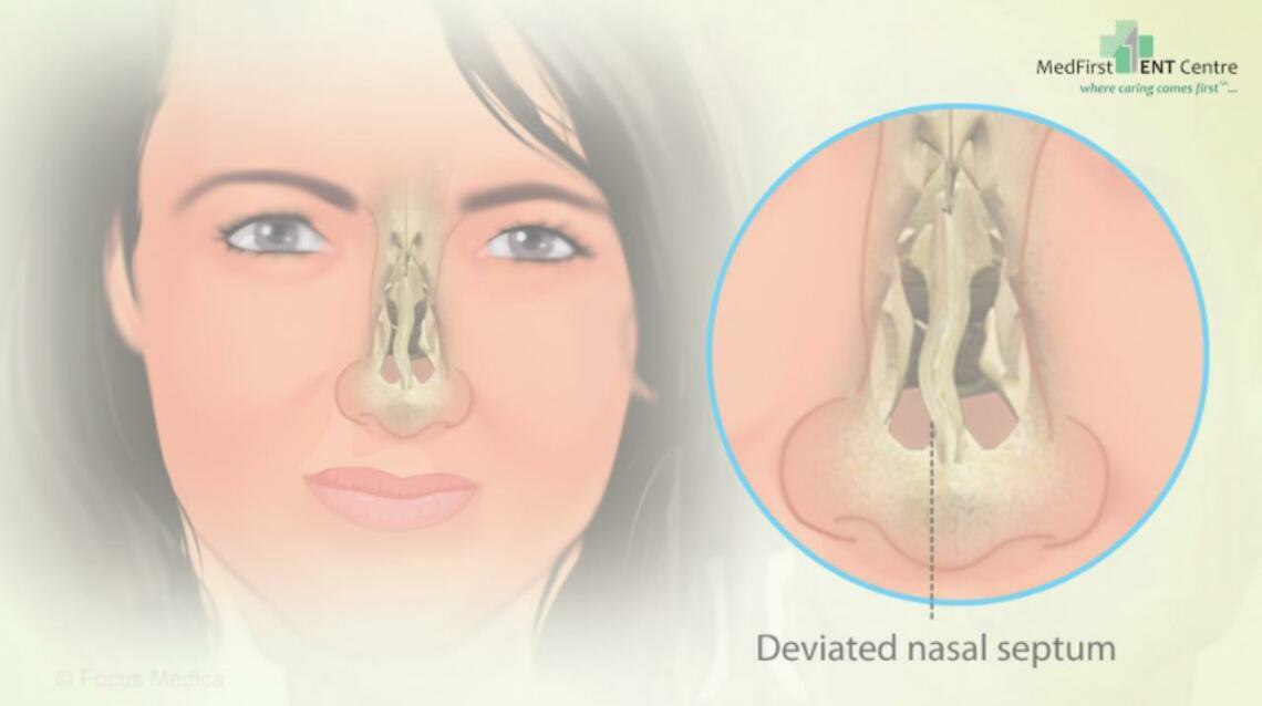 Do I Need Surgery for My Deviated Nasal Septum?