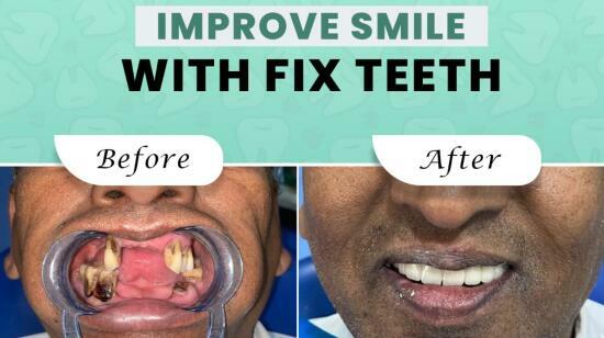 How Much Does a Dental Implant Cost in Nagpur? (Updated 2026)