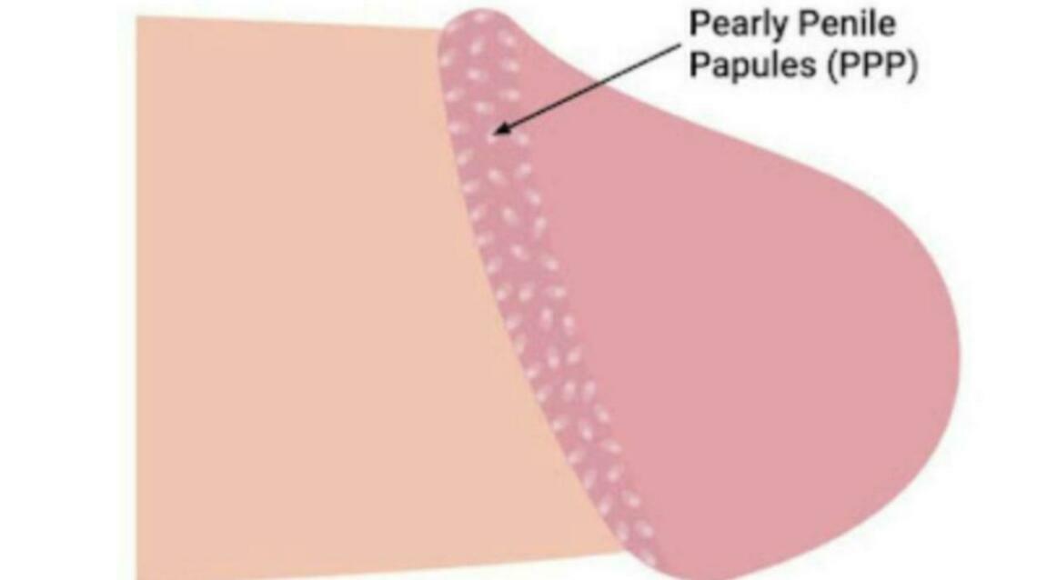 Penile Pearly Papules (Ppp)