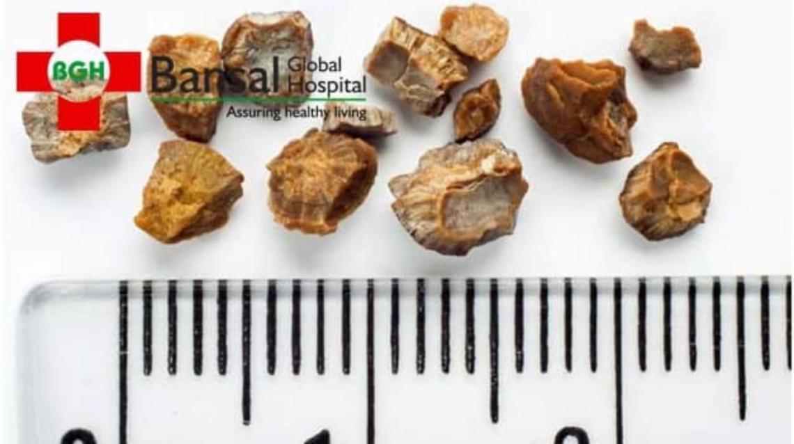 What Causes Kidney Stones?