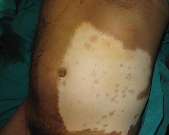 Surgical Treatment Of Vitiligo Giga Sessions