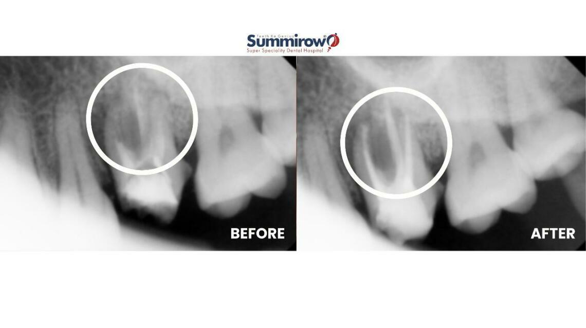 Managing Swelling and Periapical Infection in Tooth 26 – a ...