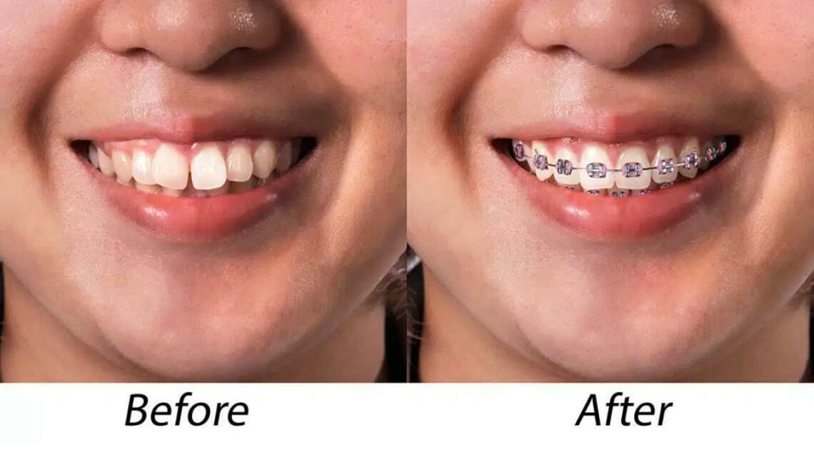 Why Not Every Crooked Tooth Needs Braces