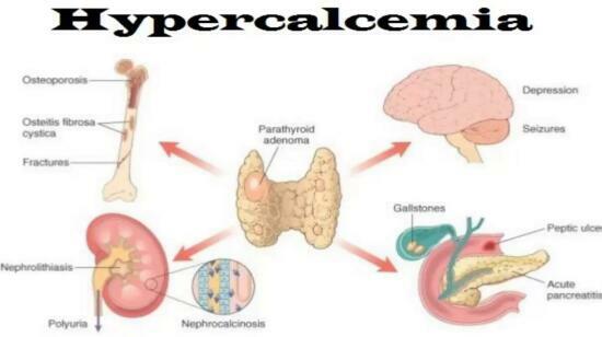 Hypercalcemia : High Calcium Level