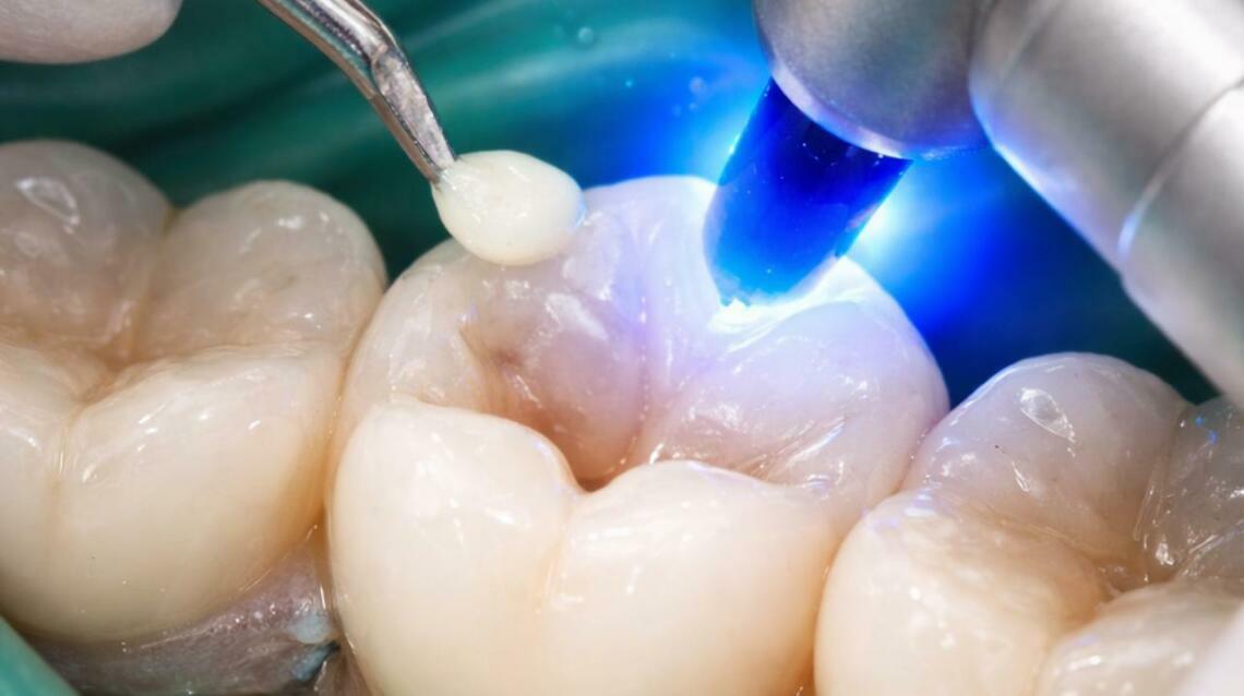 He Ignored a Small Cavity… Until It Became Big