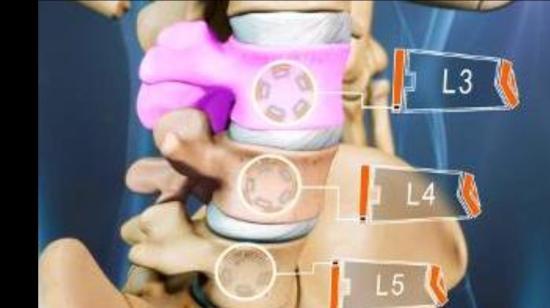 Unwanted Surgery of Spine