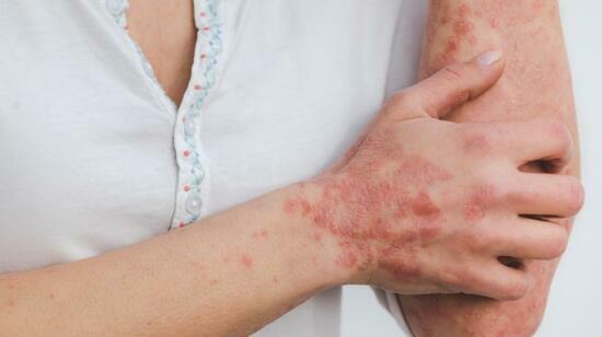 Psoriasis Is Not Just Skin Deep: It Is a Systemic Inflammatory Disease