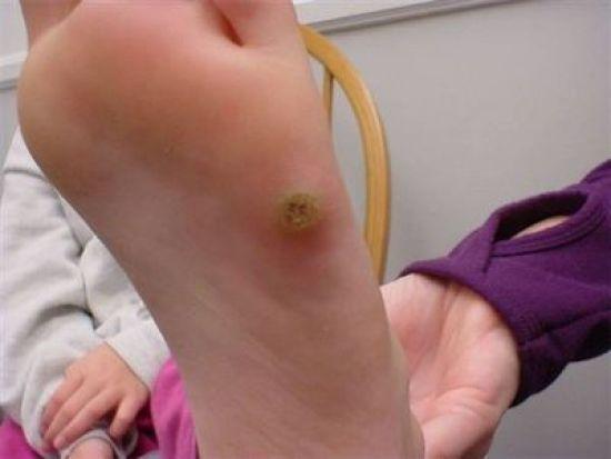Wart on foot