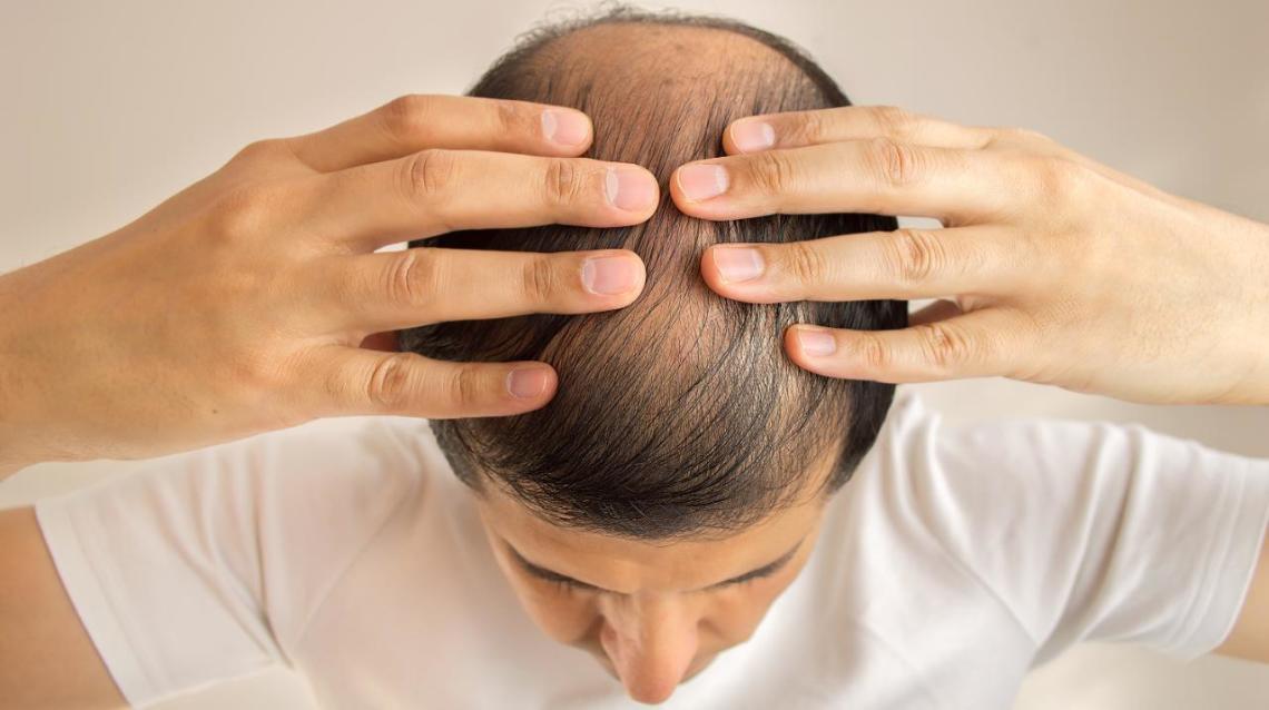 After Hair Transplants Side Effects - My Name Is Vinay..and I'm | Practo  Consult